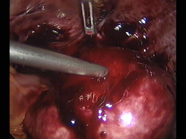 myomectomy(6)(0).jpg