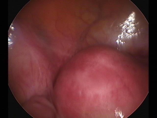 myomectomy(8).jpg
